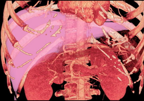 Volumen ocupado por el hígado (en rosa) en una imagen de tomografía computarizada. / Wikipedia