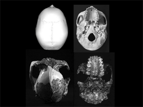 A la izquierda, vistas superior e inferior del cráneo OH5 (Paranthropus boisei). A la derecha, mismas vistas de un cráneo de Homo Sapiens.