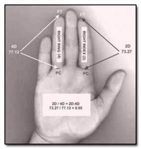 El ratio entre la longitud del dedo índice (2D) y la del dedo anular (4D), conocido como digit ratio (2D:4D), es ampliamente reconocido como un biomarcador de la exposición prenatal a la testosterona.