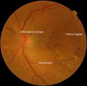 Ejemplo de patologías asociadas a la retina.