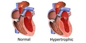 Diferencia entre un corazón normal y otro con hipertrófia. / IBS, South Korea