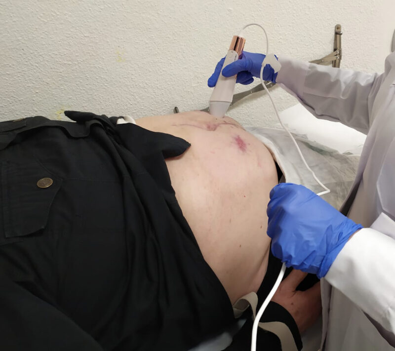 A partir de este gel, el grupo ha realizado un estudio piloto comparativo en 21 pacientes procedentes de las consultas de ostomía de los hospitales granadinos mencionados.